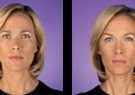 1-botox-before-after-kopelson-clinic-beverly-hills-220×105