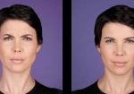 2-botox-before-after-kopelson-clinic-beverly-hills-220×105