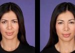 3-botox-before-after-kopelson-clinic-beverly-hills-220×105