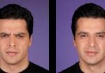 5-botox-before-after-kopelson-clinic-beverly-hills-220×105