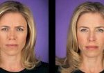 8-botox-before-after-kopelson-clinic-beverly-hills-220×105