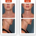 Kybella-Before-After-2