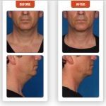 Kybella-Before-After-3