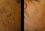 laser-resurfacing-beverly-hills-los-angeles-before-after-1-220×105