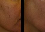 laser-resurfacing-beverly-hills-los-angeles-before-after-4-220×105