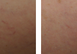 sclerorotherapy-before-after-1-220×105