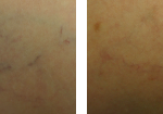 sclerorotherapy-before-after-3-220×105