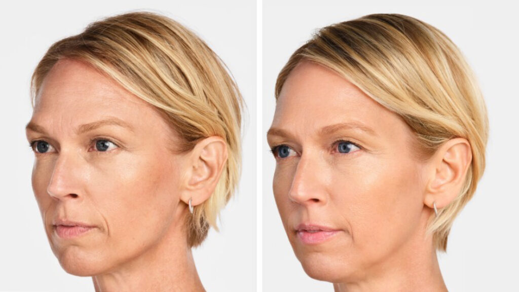 before after radiesse kopelson clinic