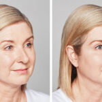 before-after-restylane-2