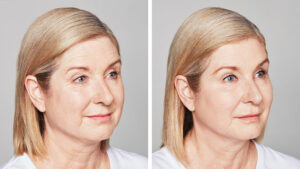 before after restylane kopelson clinic