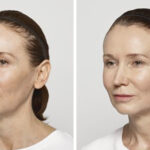 before-after-restylane-lyft-1