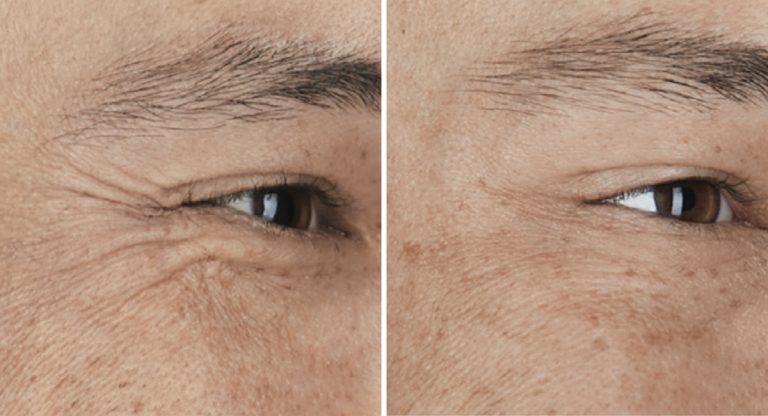 before after botox crows feet closeup