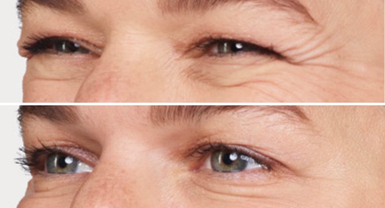 before after botox eyes crows feet