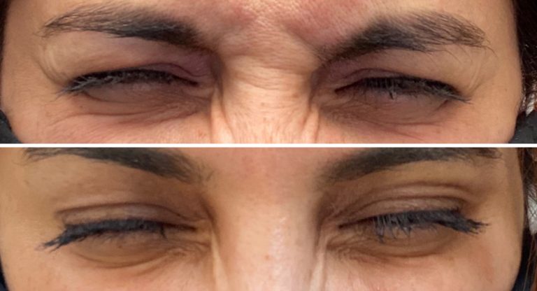 before after botox eyes crows feet bunny lines