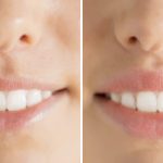 before-after-botox-lip-flip