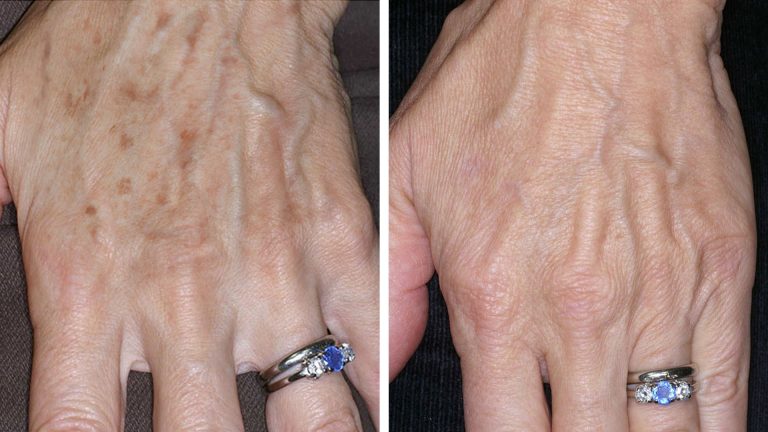 before after laser hands remove brown age spot