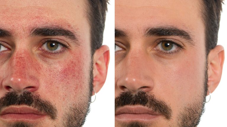 before after laser treatment for redness rosacea
