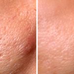 before-after-laser-uneven-tone-pore-size