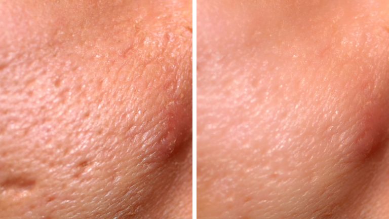 before after laser uneven tone pore size
