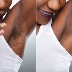 Before,And,After,Concept,Of,Woman’s,Underarm,Hair,Removal,On