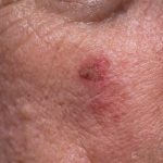 Red,Crusty,Lesions,Of,Actinic,Keratosis,Or,Sunspots,On,Sun-damaged