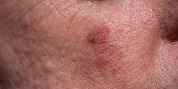 Red,Crusty,Lesions,Of,Actinic,Keratosis,Or,Sunspots,On,Sun-damaged